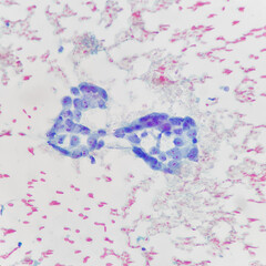 Wall Mural - Camera photo of breast carcinoma in cytology specimen, magnification 400x, photograph through a microscope