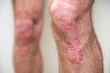 Acute psoriasis on elbows is an autoimmune incurable dermatological skin disease. Large red, inflamed, flaky rash on the knees. Joints affected by psoriatic arthritis