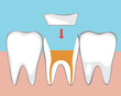 Tooth microprosthetics, Flat vector stock illustration with Canal treatment, molar depulpation and Ceramic orthodontic inlay