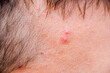 Pimples on the forehead of man. Acne on the forehead