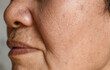 © Zay Win Htai - Enlarged pores in face of Asian, elder man with skin folds.