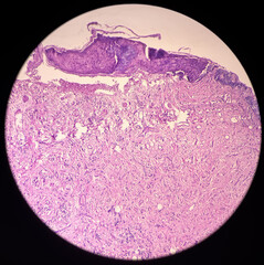 Wall Mural - Oral mucosa carcinoma: Squamous cell carcinoma, poorly differentiated, show fibrocollagenous tissue, malignant neoplasm, atypical squamous epithelial cells.