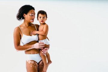 Beautiful black woman with vitiligo holding baby boy, motherhood and pregnancy concept