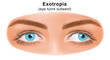 Squint eye (Strabismus). Exotropia, eye turns outward. Deflection of visual axes. Vector illustration.