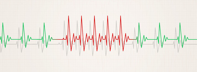 Wall Mural - sudden pulse arrhythmia medical illustration