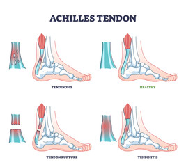 Poster - Achilles tendon injury as leg or ankle trauma outline diagram. Labeled educational inflammation and orthopedic ligament conditions vector illustration. Tendinosis, rupture and tendinitis problem.