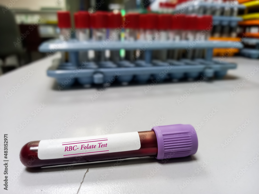 Blood sample tube for RBC Folate test. To measures the amount of folate ...