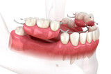Fototapeta Kosmos - Removable partial denture, mandibular prosthesis. Medically accurate 3D illustration of prosthodontics concept