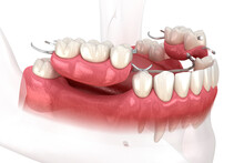 Removable Partial Denture, Mandibular Prosthesis. Medically Accurate 3D Illustration Of Prosthodontics Concept