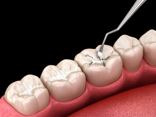 Wall Mural - Molar tooth fissure restoration with filling. Medically accurate tooth 3D illustration.