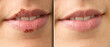 © Alessandro Grandini - Macro of a woman's lips before and after herpes treatment
