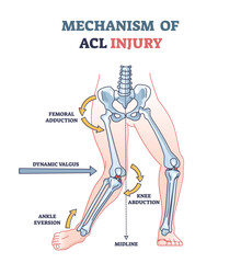 Canvas Print - Mechanism of ACL injury as knee trauma anatomical explanation outline diagram. Labeled educational anterior cruciate ligament twist, abduction, ankle eversion and femoral adduction vector illustration