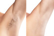 Comparison of female armpit after hair removal