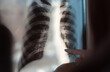Woman doctor hands holding patient chest x-ray film before treatment