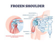 Frozen shoulder condition or adhesive capsulitis syndrome outline diagram. Labeled educational medical diagnosis with pain and stiffness around body upper part with movement limits vector illustration