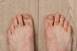 Feet of a man close-up of fingers affected by a fungal nail plate. Ugly toes.