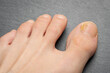 Toenails with fungus problems,Onychomycosis, also known as tinea unguium, is a fungal infection of the nail, gray background.