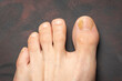 © robertobinetti70 - Toenails with fungus problems,Onychomycosis, also known as tinea unguium, is a fungal infection of the nail, dark background.
