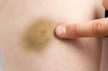 Close-up Image Of A Doctor Who Indicates With A Finger The Bruise On The Skin As A Result Of A Blow To The Leg