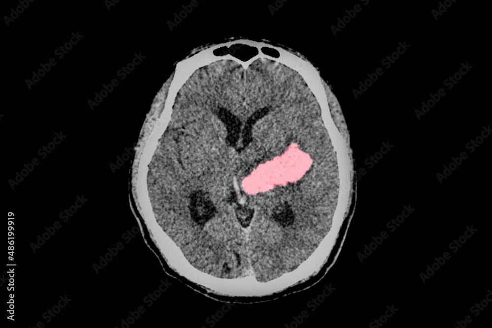 A computer tomography image of brain and skull showing large ...