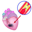 ischemia of the heart. Vascular atherosclerosis. damage to the coronary arteries. Fatty plaques on the walls. Blood clots. High risk of death. Vector illustration.