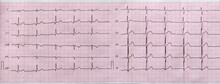 Electrocardiogram Close-up On Paper, Cardiology And Health Care