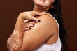 © Leire Cavia/Stocksy - Portrait of an anonymous girl with vitiligo skin