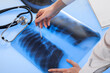 Doctor examines x-ray image of lungs lying on the light table.