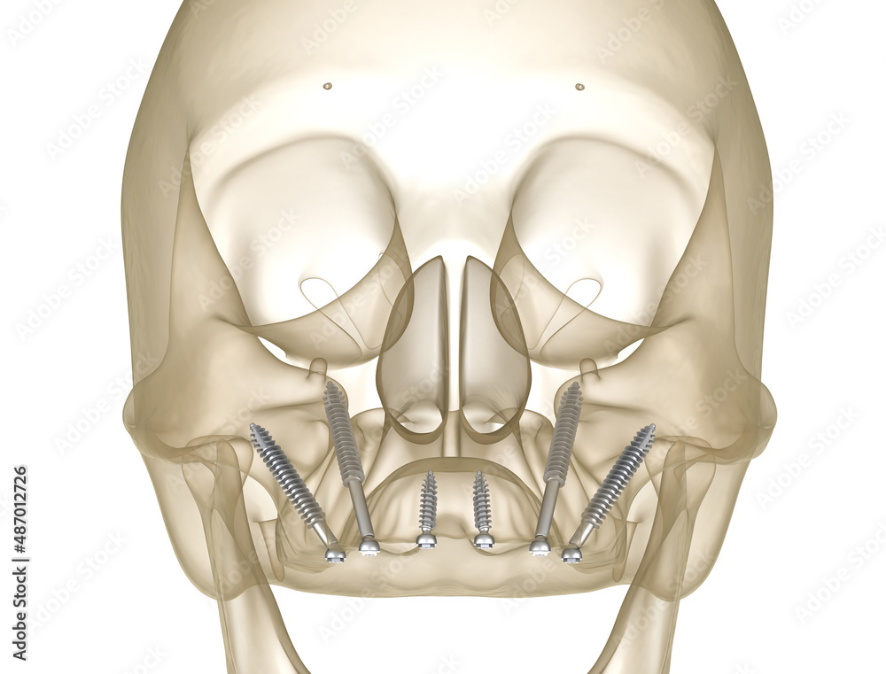Maxillary Prosthesis Maxillary prosthesis supported by zygomatic implants. Medically ...