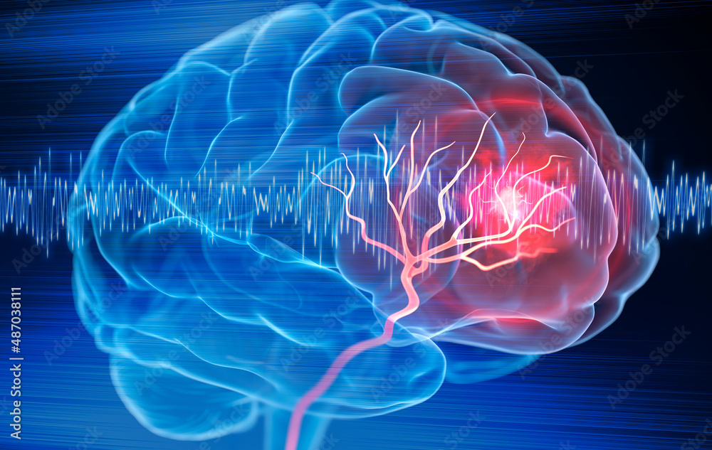 X- Ray illustration of brain stroke - 3d Illustration Stock ...