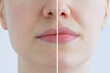 © Iuliia Alekseeva - Augmentation of the lips of caucasian woman close-up. Cosmetic injections. Before and after.