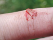 © daily_creativity - Injured finger with bleeding open cut. Deep wound. the injured finger with a dirty open background