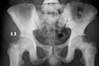 x ray image of prostat cancer metastasis on pelvis bone,difuse osteoblastic lesion