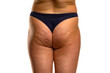 © vladimirfloyd - woman's buttocks with problematic skin and pimples and cellulite
