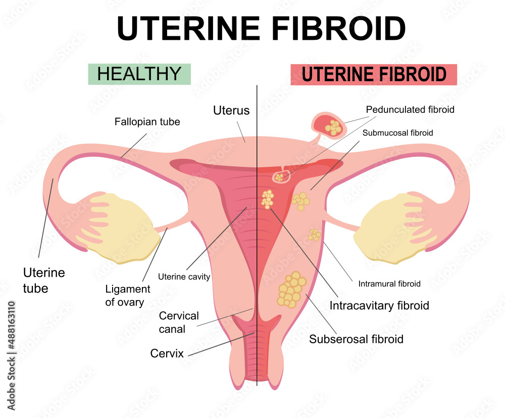 Types of uterine fibroids. Disease of the female reproductive system.  Reproductive system picture displays pedunculated, intracavitary,  submucosal, subserosal. Flat illustration of myoma, leiomyomas. Stock  Vector | Adobe Stock, image size:1000x829