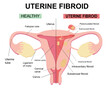 © Ekaterina  Siubarova - Types of uterine fibroids. Disease of the female reproductive system. Reproductive system picture displays pedunculated, intracavitary, submucosal, subserosal. Flat illustration of  myoma, leiomyomas.