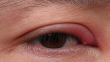 Close-up Of A Male's Eye Stye. Red Upper Eye Lid With Onset Of Stye Infection Due To Clogged Oil Gland And Staphylococcal Bacteria.