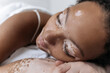 © Westend61 - Woman with vitiligo sleeping at home