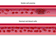 Diagram of comparison Blood flow between sickle cell disease and normal blood vessels.