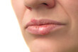 © BearOK - Herpes virus. Herpes disease on the lips of a 30 year old woman. Infectious virus. Close-up of the manifestation of herpes on the lips.