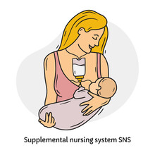 A Woman Breast-feeds A Baby With Supplemental Nursing System SNS And Lactation Aid Vector Cartoon Illustration. Device For Breast Milk And Infant Formula