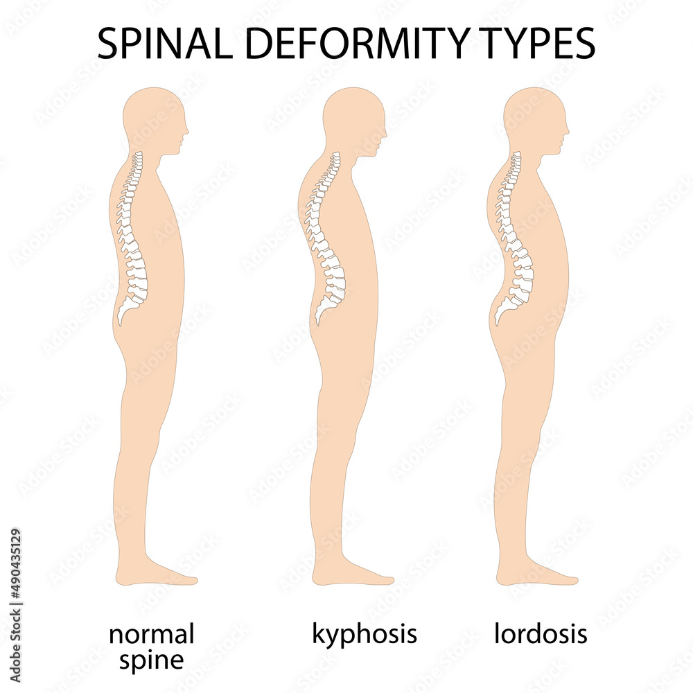 Vektor Spine deformity vector illustration. Kyphosis, lordosis spine ...