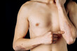 © fusssergei - Acute psoriasis on the elbows is an autoimmune incurable dermatological skin disease. A large red, inflamed, flaky rash on the elbows. Joints affected by psoriatic arthritis
