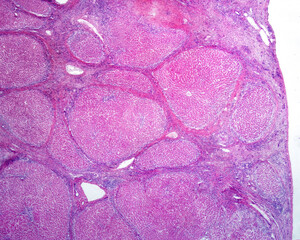 Poster - Human liver. Cirrhosis