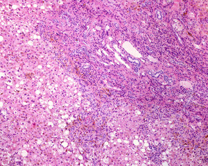 Poster - Human liver. Cirrhosis