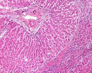 Poster - Human liver. Cirrhosis