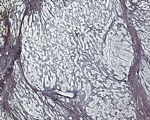 Poster - Human liver. Cirrhosis. Silver stain