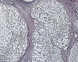 Poster - Human liver. Cirrhosis. Silver stain