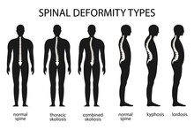 Spine Deformity Vector Illustration. Kyphosis, Lordosis Spine Infographic. Diagram With Spine Curvature And Healthy Spine. Posture Defect. Medical, Educational And Scientific Banner