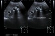An ultrasound image of gallstone
